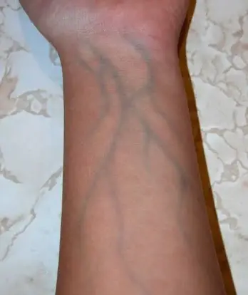 How to Get Rid of Green Veins Caused by Bleaching Cream
